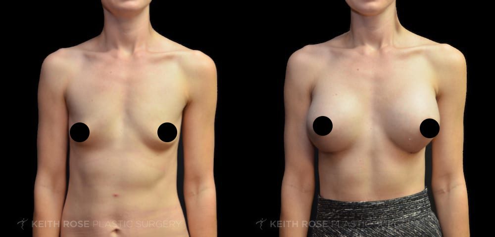 chris bundalian recommends best natural breast tumblr pic